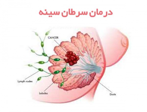 درمان سرطان سینه در یزد