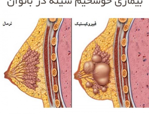 بیماری خوشخیم سینه در بانوان