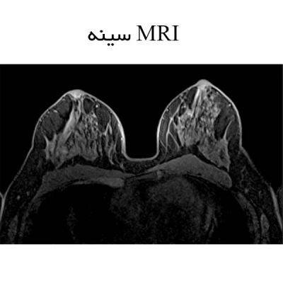 MRI سینه