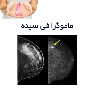 ماموگرافی سینه - خیریه bcpi