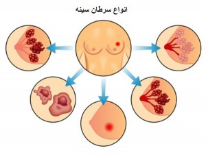 انواع سرطان سینه 