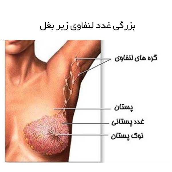 کیست زیر بغل چه علائمی دارد؟