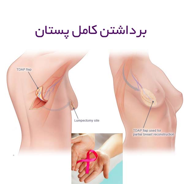 غدد لنفاوی زیر بغل - bcpi سرطان سینه