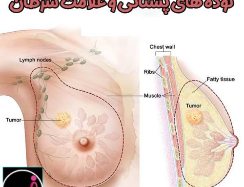 توده پستانی + علامت سرطان
