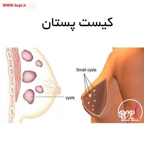 عکس کیست پستان - بی سی پی آی