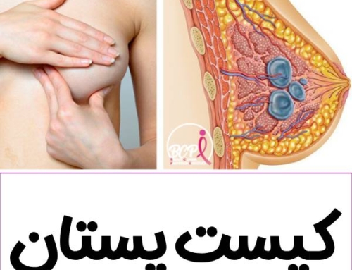 کیست پستان چیست + علائم و درمان