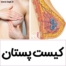 عکس کیست پستان