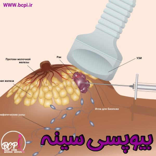 بیوپسی سینه