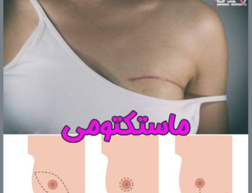 نقش ماستکتومی در درمان سرطان سینه + روش ها