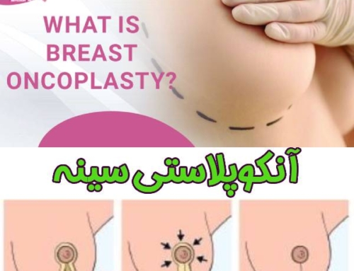 آنکوپلاستی سینه چیست؟