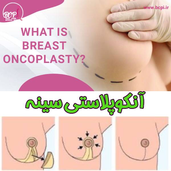 آنکوپلاستی سینه - موسسه خیریه bcpi